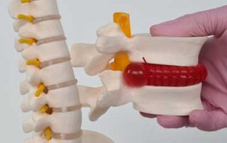 Can a Chiropractor Help My Herniated Disc?