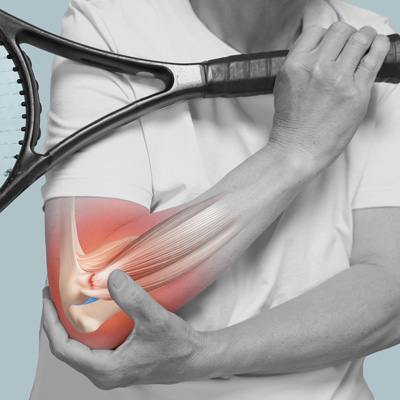 Tennis Elbow Chiropractor
