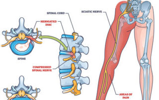 Sciatica vs Piriformis Syndrome