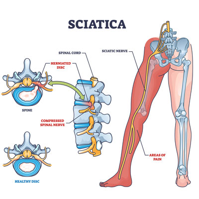 Sciatica vs Piriformis Syndrome