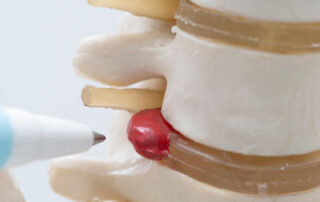 Can You Make a Herniated Disc Worse
