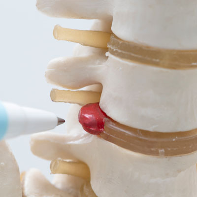 Can You Make a Herniated Disc Worse